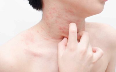 Why Are My Hives Not Going Away? Introducing the Chronic Urticaria Toolkit