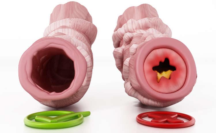 Medical drawing of obstructed and unobstructed bronchial tubes