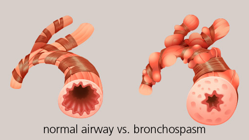 Illustration of a Bronchospasm