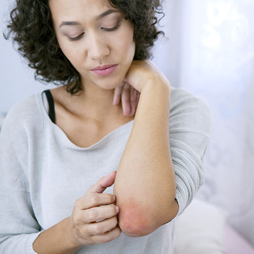 Photo of woman scratching a rash on her elbow