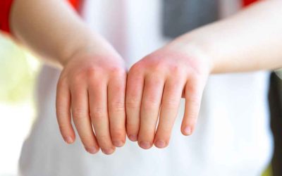 Eczema Study Now Enrolling Paid Volunteers