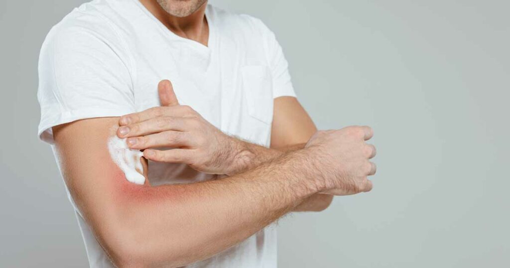 Man putting cream on his moderate eczema on the inside of his elbow