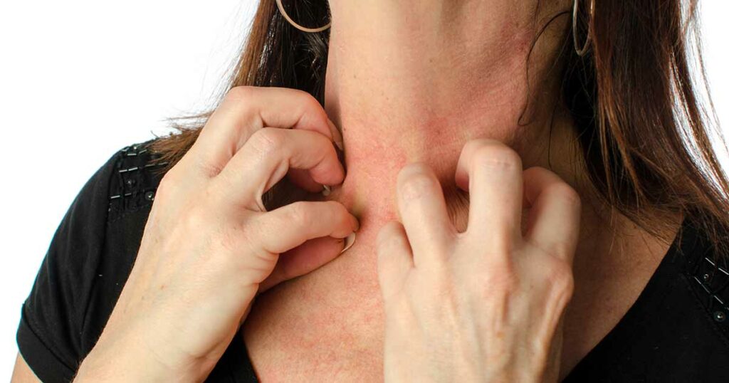 Woman scratching her neck because of moderate eczema