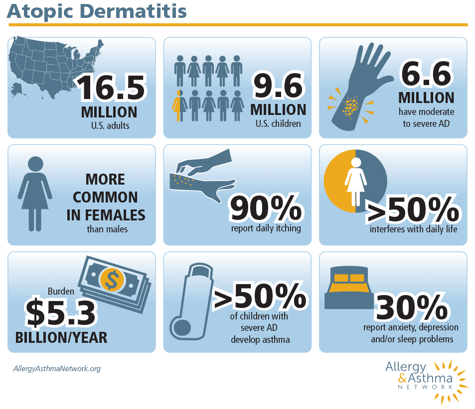 updated statistics on Atopic dermatitis