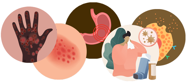 Graphic of mast cell disease indicators showing: hives, gastric issues, anaphylaxis.