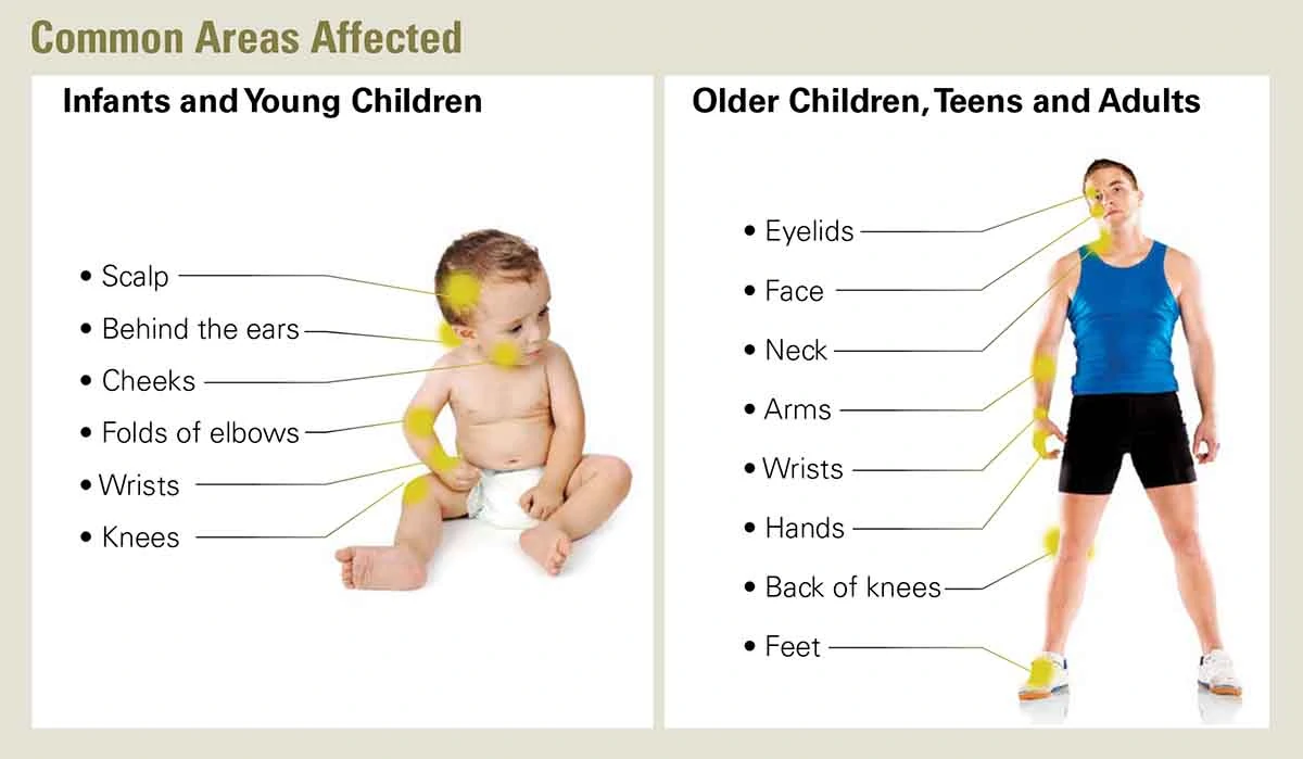 Graphic showing the common areas effected by eczema